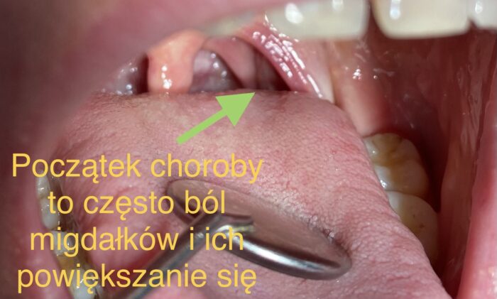 Wygląd migdałków